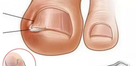 Тырнақ «ішке өсіп», етті ауыртса не істеу керек