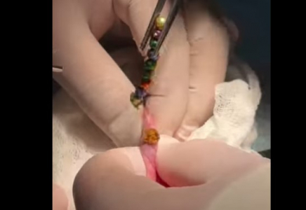 ​В Шымкенте врачи провели сложную операцию ребенку, проглотившему 16 магнитов