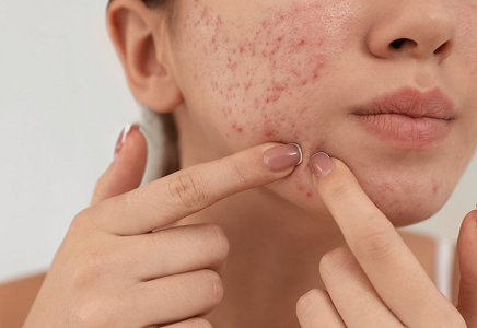 ​Жасөспірімдік шақтағы безеуді қалай кетіруге болады?