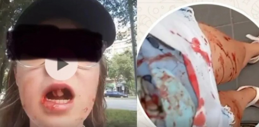 Жақ сүйегі сынып, екі тісі түсіп қалған: Қызды қағып, қашып кеткен электровелосипед жүргізушісі ұсталды 