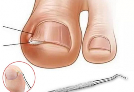 Тырнақ «ішке өсіп», етті ауыртса не істеу керек