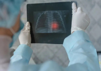 Астана мен Алматыдағы екі университет студенттерінен туберкулез анықталды