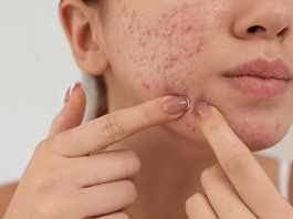 ​Жасөспірімдік шақтағы безеуді қалай кетіруге болады?