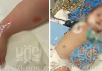 Астанада 9 айлық сәби ауруханада емделу кезінде күйіп қалған