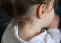 Қазақстанда қызылшаға қарсы екпе алмаған балалар мектеп пен балабақшаға уақытша кіре алмайтын болды