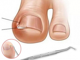 Тырнақ «ішке өсіп», етті ауыртса не істеу керек