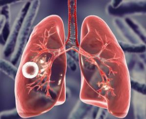 Түркістан облысында туберкулезге шалдығу деңгейі төмендеген