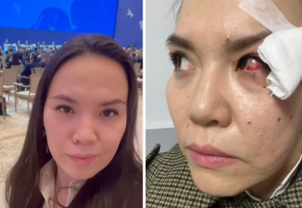 Қабағы жыртылып, қан құйылған: Астанадағы форумға барған әйел көзін жаралап алды