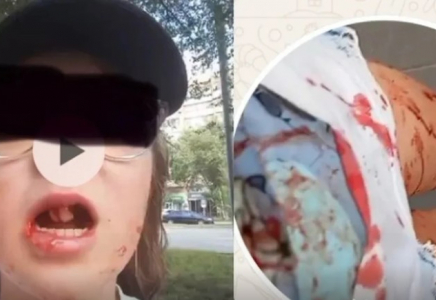 Жақ сүйегі сынып, екі тісі түсіп қалған: Қызды қағып, қашып кеткен электровелосипед жүргізушісі ұсталды 