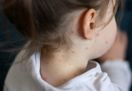 Қазақстанда қызылшаға қарсы екпе алмаған балалар мектеп пен балабақшаға уақытша кіре алмайтын болды