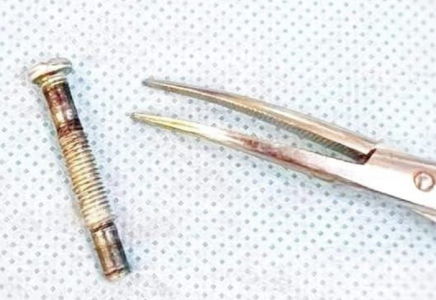 Түркістандық дәрігерлер темір бұранда жұтып қойған баланы аман алып қалды