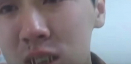 Әскердегі соққы: Жақ сүйегі сынған сарбазды туыстарынан жасырған 