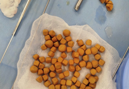 ТҮРКІСТАН: Науқастың қуығынан 80 тас алынды