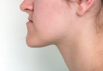 Иектің алға шығуы сақаулыққа апарады